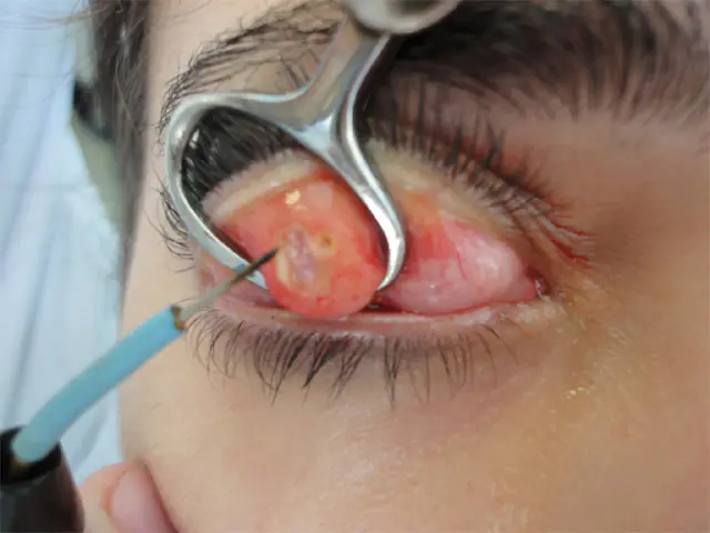 Chirurgická intervence pro chalazion očního víčka