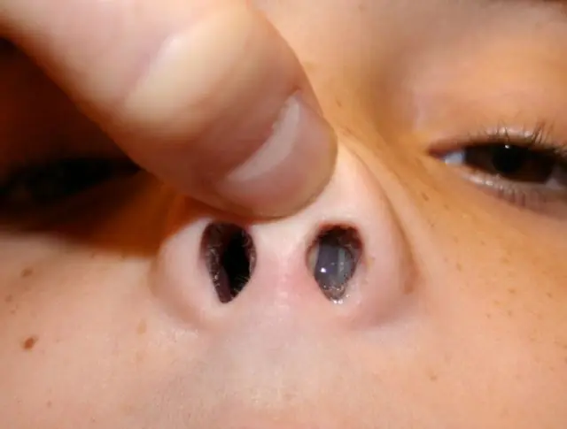 Brodawczak odwrócony nosa u dziecka