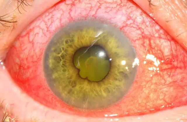 Silmän iridosykliitti