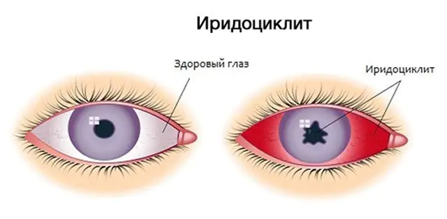 iridociclitis del ojo