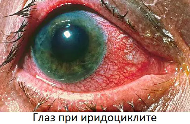 Iridociclitis del ojo