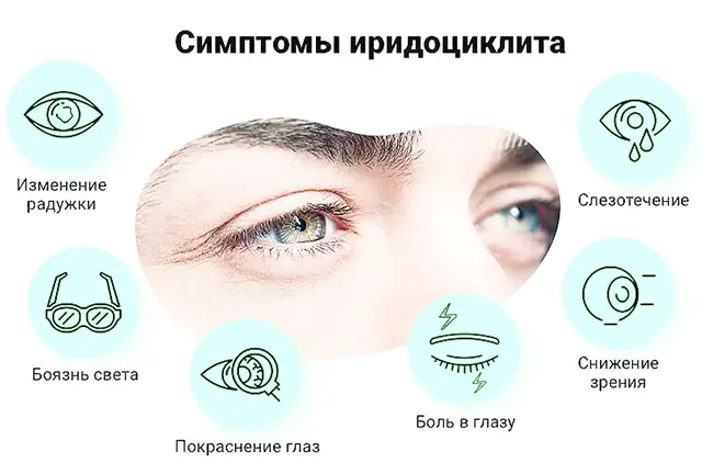 Symptômes de l'iridocyclite oculaire