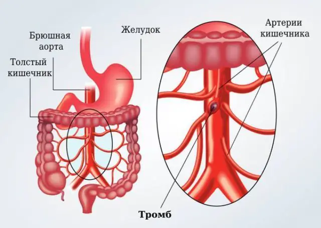 Причини розвитку ішемії кишечника