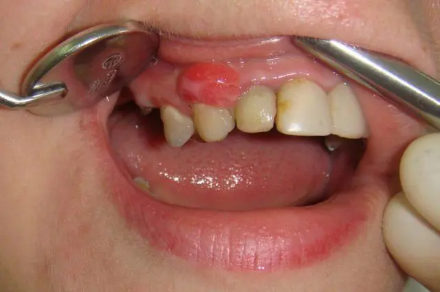 Diagnosis of papillomas in the mouth