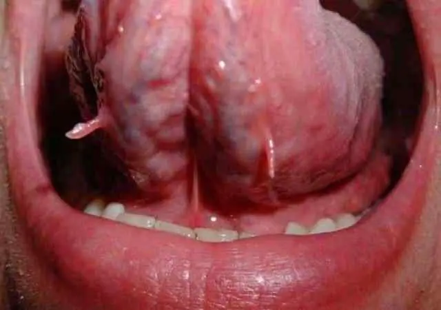 口の中の乳頭腫はどのように見えますか?