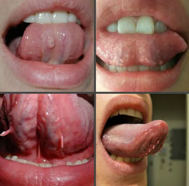 What do papillomas look like on the tongue?