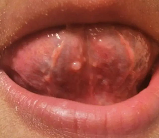 HPV under the tongue