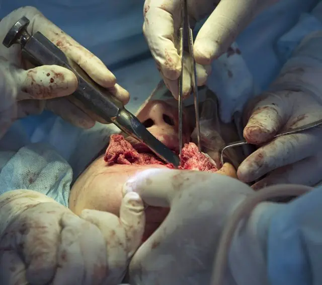 Escisión quirúrgica de papilomas en la boca.