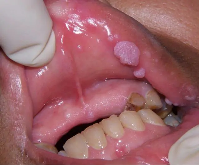 Papilomas na boca