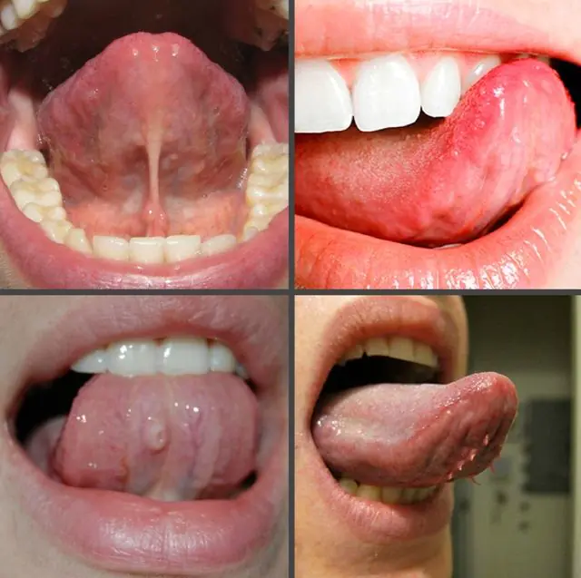 Papilomas en la boca debajo de la lengua.