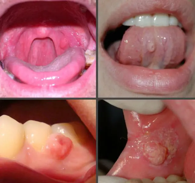 What do papillomas look like in the mouth?