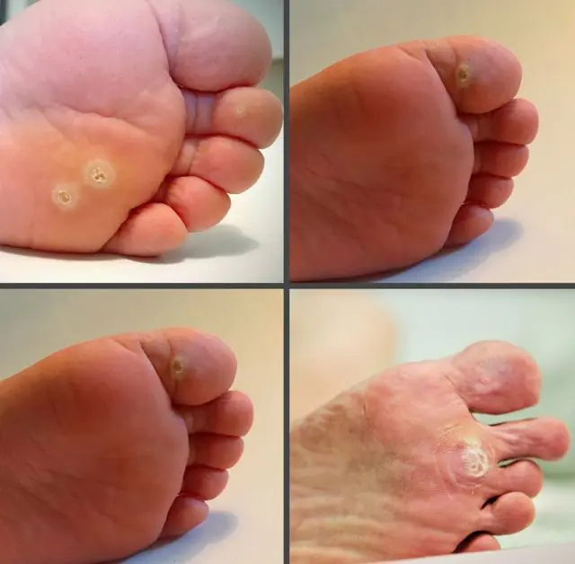 What do plantar warts look like?