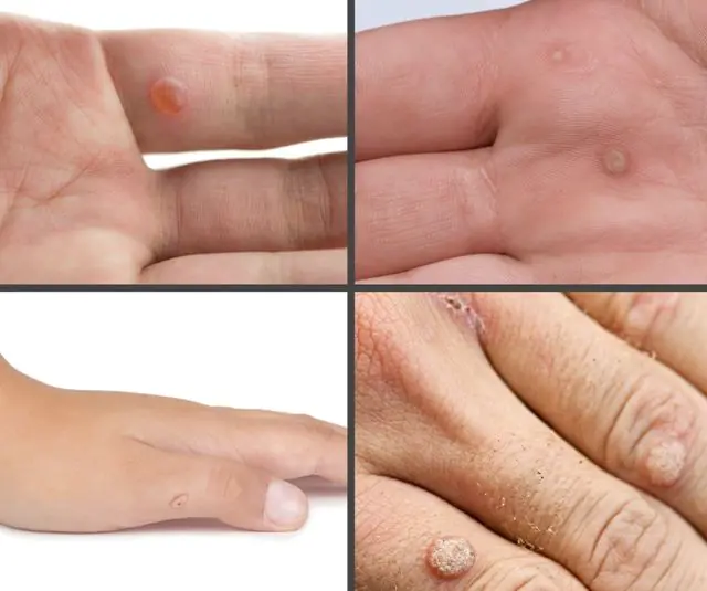 What do warts on the hand look like?