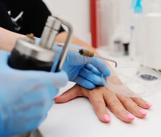 Cryoremoval of warts on the hands