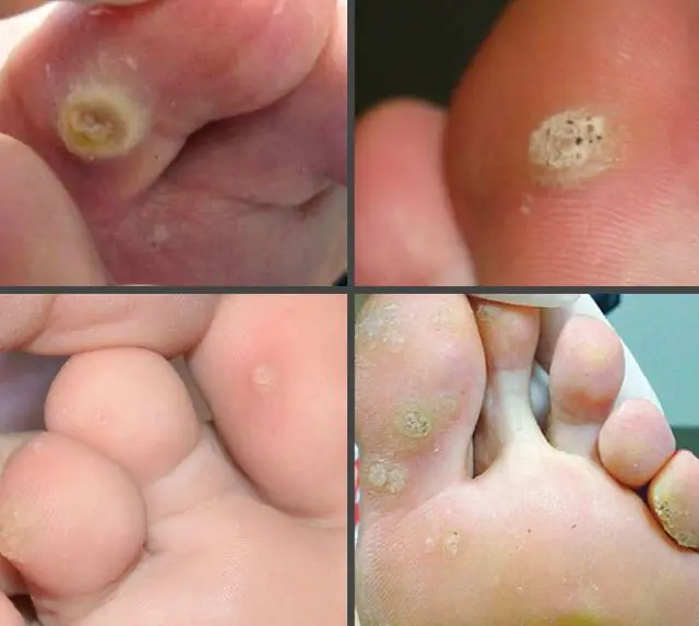 What does papilloma on the toe look like?