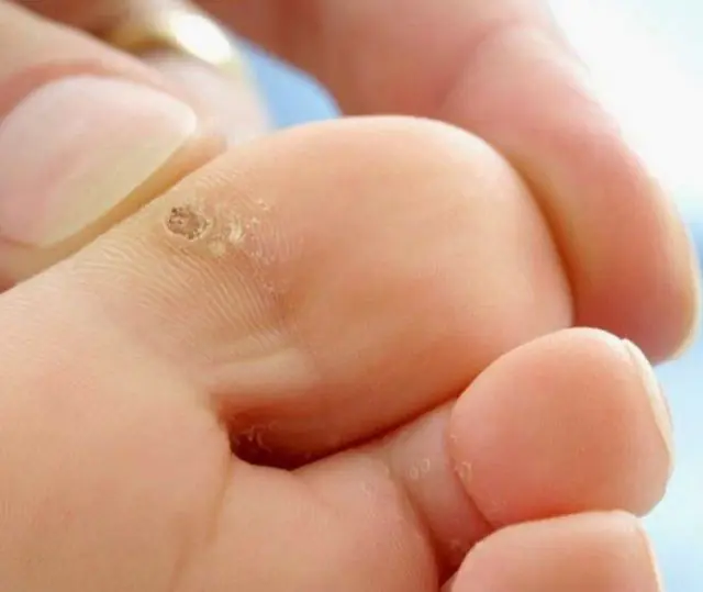 Papiloma en el dedo del pie