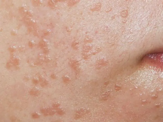Flat warts on the face