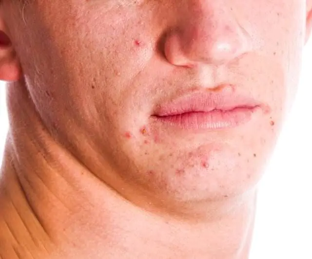 Akne im Gesicht eines Mannes