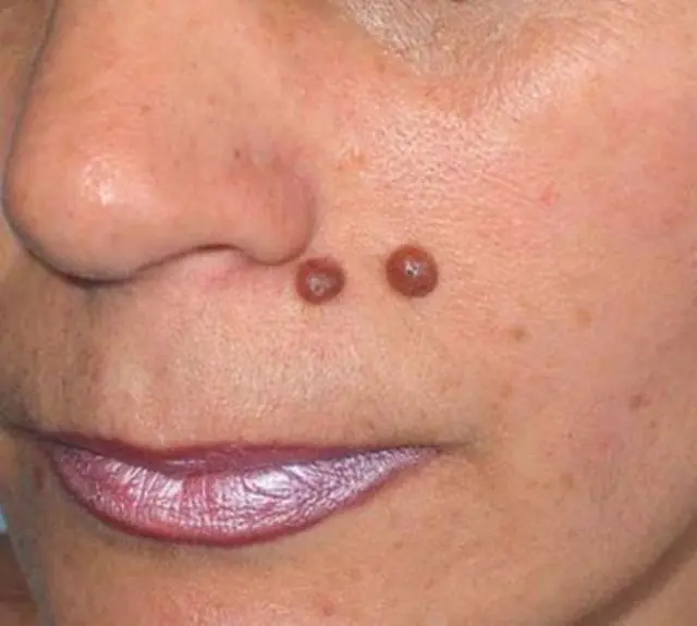 Wart on a woman's face