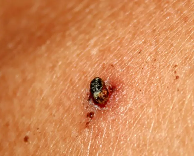 Degeneratie van papilloma tot melanoom