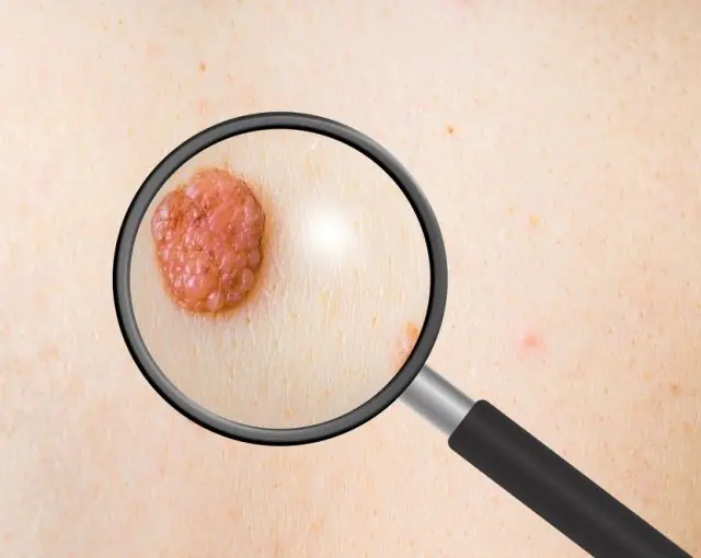 What is the difference between papilloma and melanoma?
