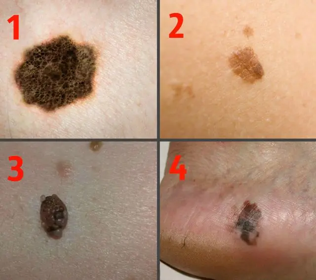 Types of melanomas