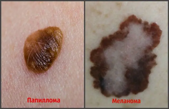 Papilloma en melanoom