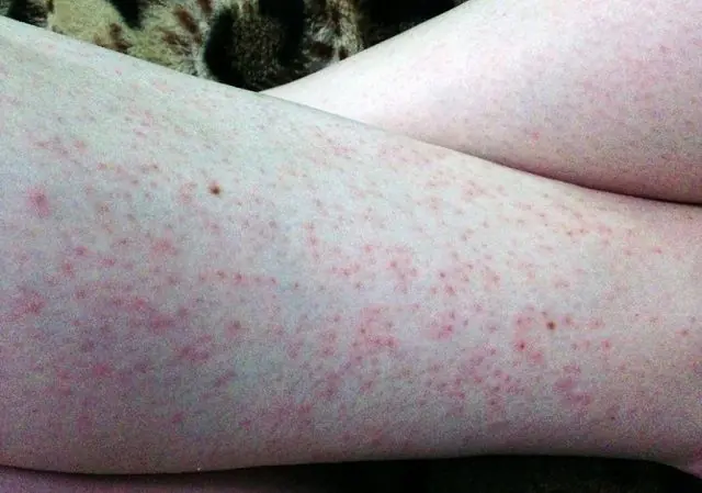 Folliculitis after hair removal on legs