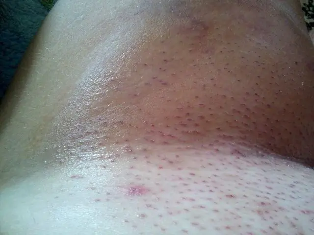 Folliculitis after hair removal in the armpit area