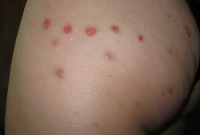 Furunculosis on the thighs as a complication of folliculitis after hair removal