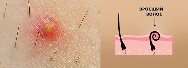 Pêlos encravados após depilação
