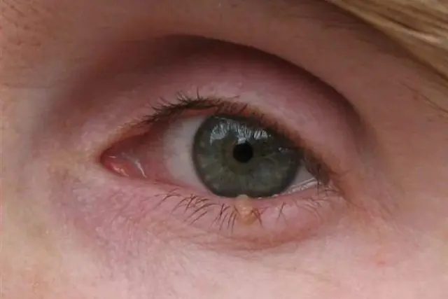 Papilloma op het ooglid