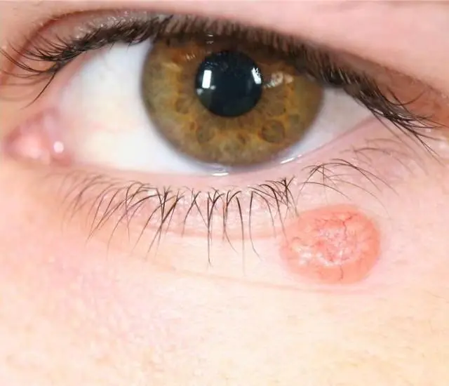 Papilloma under øjet