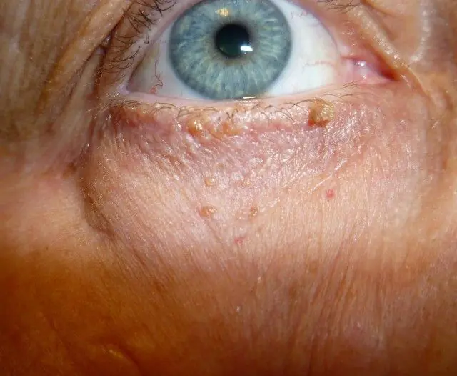 目の下の乳頭腫はどのように見えますか?