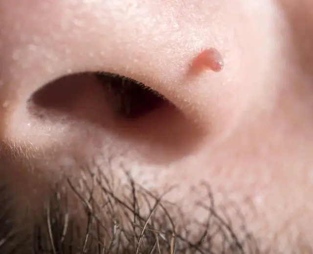 Papilloma on the nose