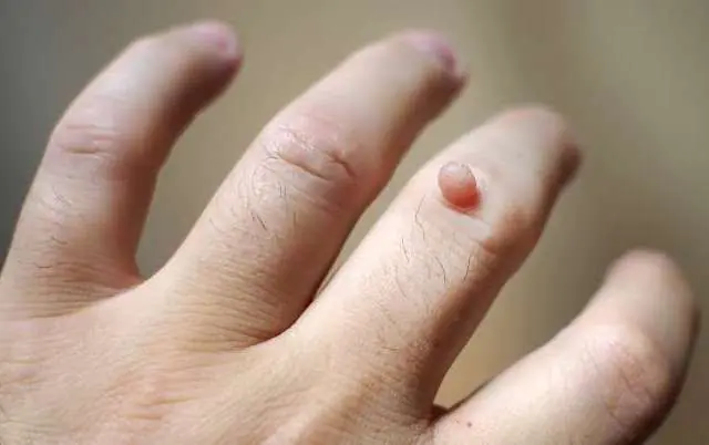 Hvordan ser papilloma ut på en finger?