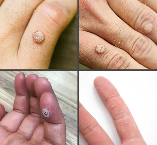 指にできる乳頭腫はどのように見えますか?