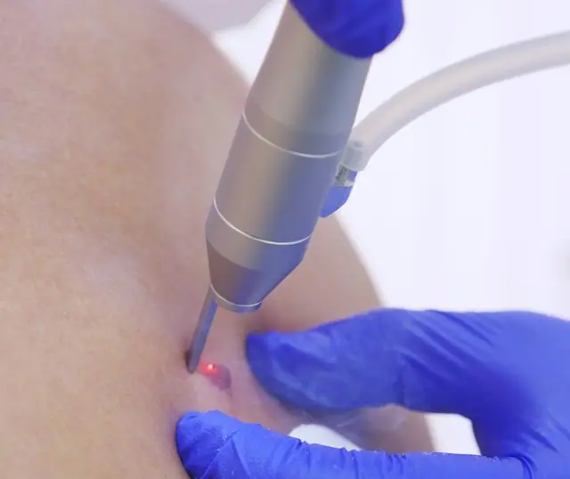 Removal of papilloma on the leg