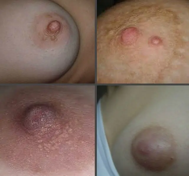 What do papillomas on the nipples look like?