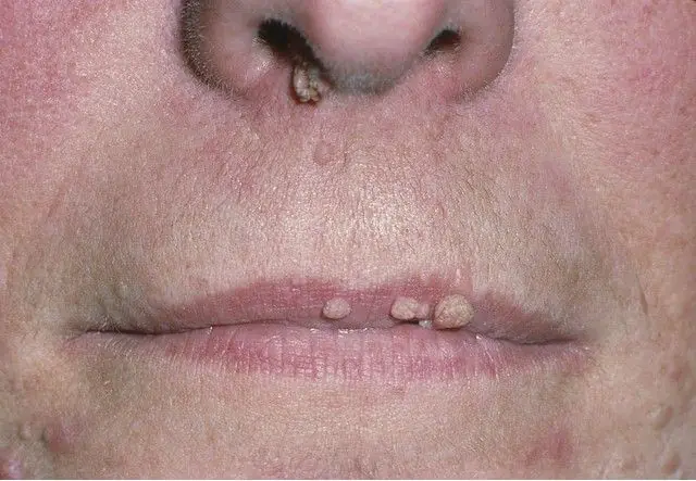 Types of papillomas on the face
