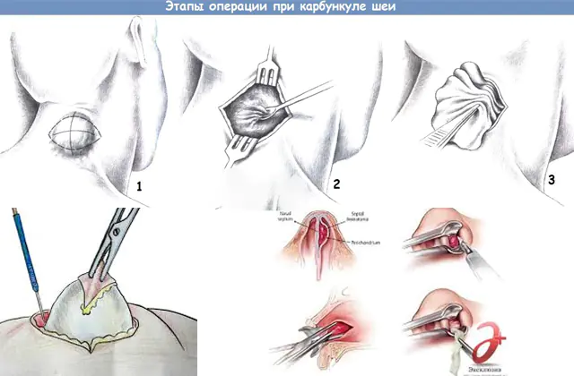 Stadien der Operation eines Halskarbunkels