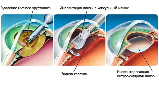 Операція з видалення катаракти