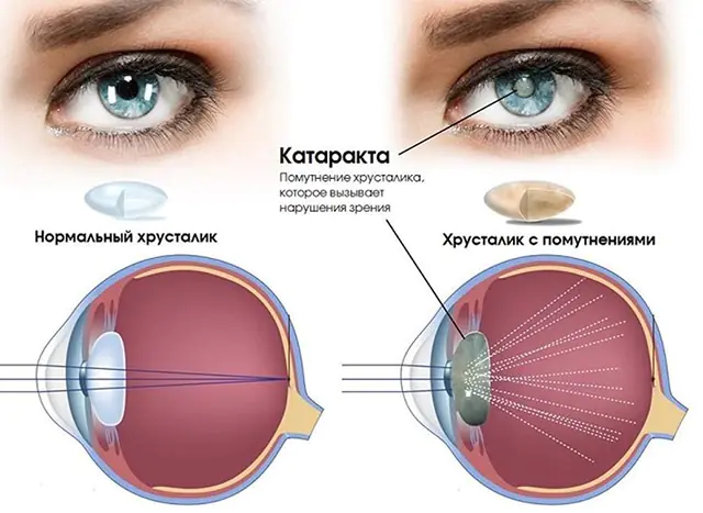 Cataract van het oog