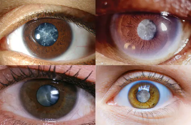 triệu chứng đục thủy tinh thể ở mắt