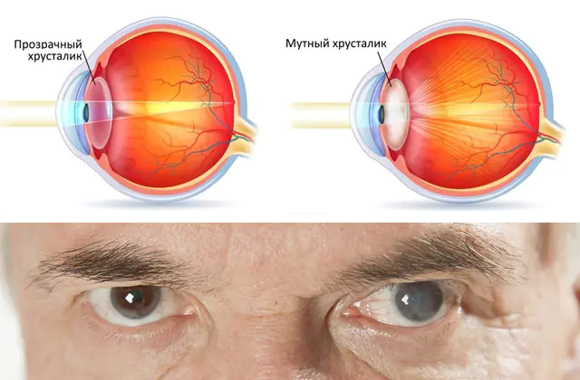 Gözün kataraktası