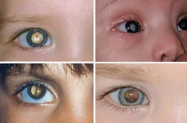 cataract in a child