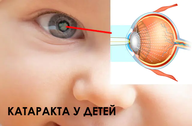Cataracts in children
