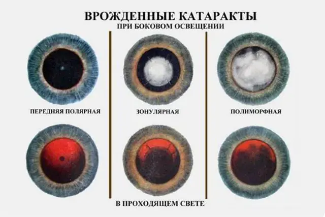 Types of congenital cataracts in children
