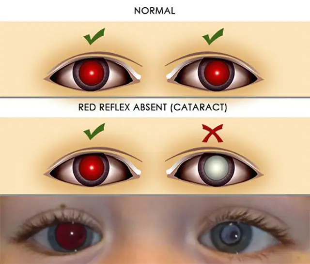Diagnosis of cataracts in children