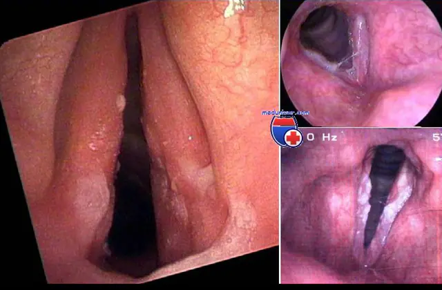 Laringitis crónica